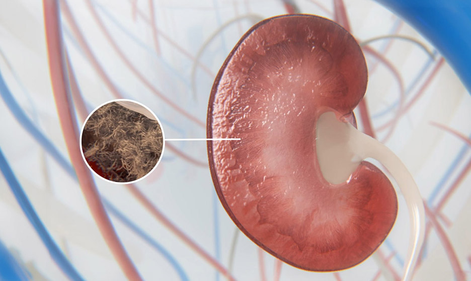 Kidney fibrosis - Zoetis